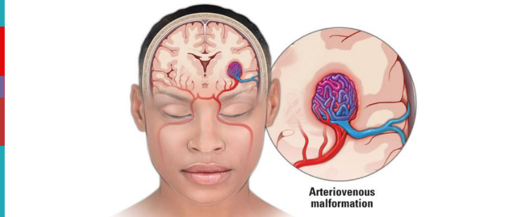 arteriovenous malformation (AVM)