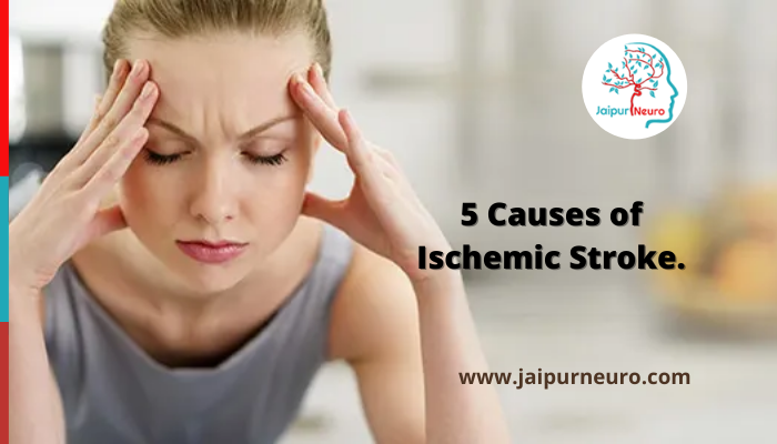 5 Causes of Ischemic Stroke